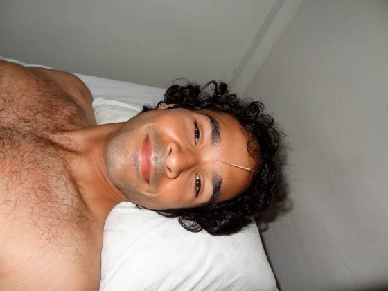 Acupuncture