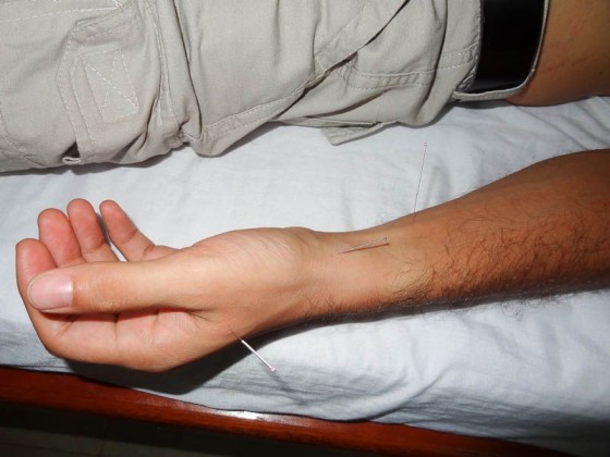 Acupuncture