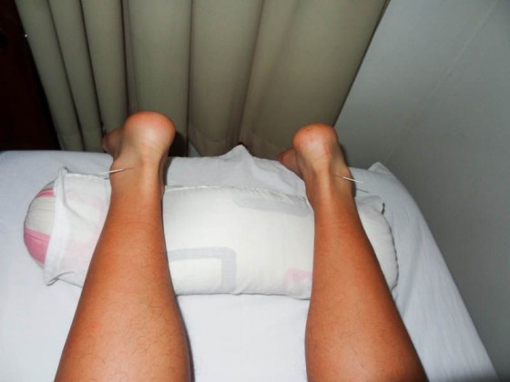Acupuncture