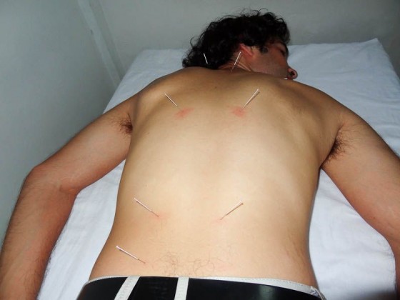 Acupuncture