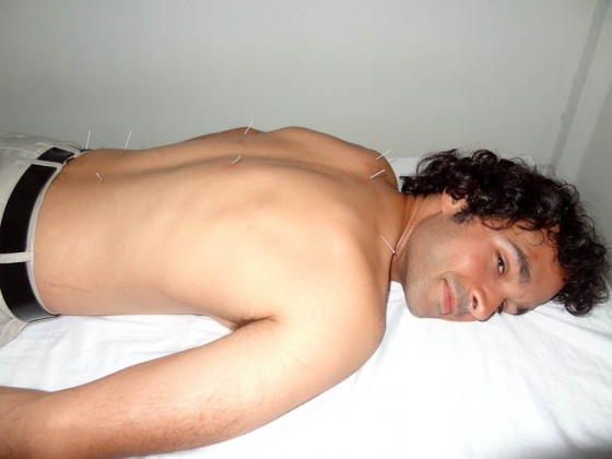 Acupuncture